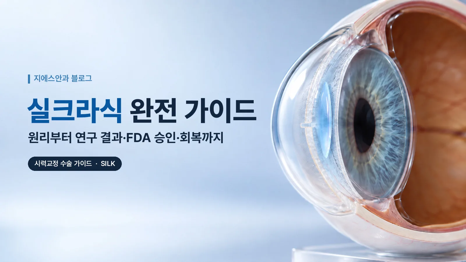 실크라식 완전 가이드 — 원리부터 연구 결과·FDA 승인·회복까지